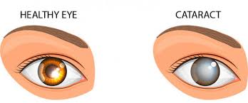 There are two different types of photoreceptors, ones that are particularly good at seeing colors in bright light and others that see greyscale images in dim light. Cataracts Spokane Eye Clinic