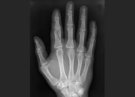 Spiral fracture — beware the horns 03:03. Finger Fractures