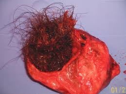 The way to therapy Pilonidal Sinus