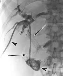 Patients with severe cardiac diseases and copd should not be considered a good candidate for laparoscopy. Diagnosis And Management Of Complications From Percutaneous Biliary Tract Interventions Radiographics