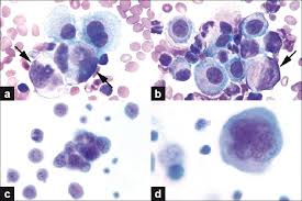 This paper aims to report a case of mesothelioma in a dog, obtained from the cytological analysis of pleural and abdominal fluid, which allowed an in vivo diagnosis. View Image Mesothelioma Cancer Basic Facts