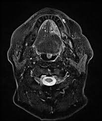 Image result for spinocellular carcinoma of the oral cavity