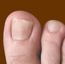 Toe fungus is unlikely to cause serious issues for healthy people, but it can be embarrassing and pa… our top toenail therapies & remedies. Types Of Toenail Fungus Pictures Awesome Nail