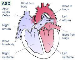 Atrial Septal Defect Asd Congenital Acyanotic Heart Defect In Which The Atrial Septum Does Not Fu Atrial Septal Defect Congenital Heart Disease Picu Nurse