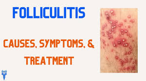 Image result for folliculitis symptoms