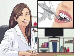Gently brush in between the braces; How To Brush Your Teeth With Braces On With Pictures Wikihow