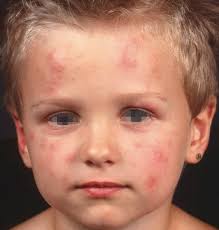 Image result for Papular urticaria