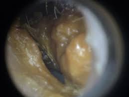 Earwax removal videos are the satisfying youtube trend you never knew you needed. Ear Wax Removal Sydney Do You Need To Clean Your Ears Daily Telegraph