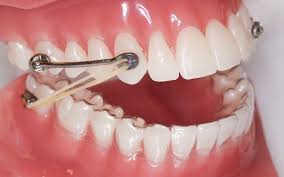Johns dental has been fabricating star appliances for more than 25 years. All About The Carriere Motion Appliance Cma Bronsky Orthodontics Nyc