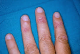 Annular lichen planus (lp) is a rare form of lichen planus, which is a condition that affects the skin and/or mouth. Annular Atrophic Lichen Planus Sciencedirect