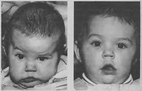 Computer guides facial reconstruction