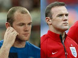 Pele also said that rooney is very much similar to him. 8 Football Players Who Had Hair Transplantation Cosmeticium