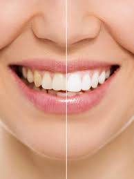 Es gibt streifen zum aufkleben oder gel zum auftragen. Wie Bekomme Ich Meine Zahne Auf Naturliche Weise Weisser Wunderweib