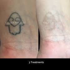One client quick 8 stage before and after laser tattoo removal video via our clinic in hull, uk. Before After Gallery Tattoo Removal In Miami