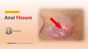 After that, anything can happen. Anal Fissure Surgery Video Lectures Medical Education V Learning Sqadia Com Youtube