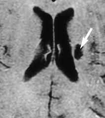 Image result for Pallidotomy