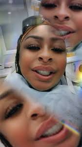 Bionic Smile Dental Implant Experience in Vegas