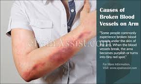 These are easier to get rid of with laser and cautery procedures. Causes Of Broken Blood Vessels On Arm Home Remedies To Get Rid Of It