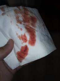 Breakthrough bleeding is any bleeding or spotting you may experience between your normal you may even notice that the blood you see is dark brown, which may mean that it's old blood. Implantation Bleeding Fast Reply Please Pregnancy Babycenter India
