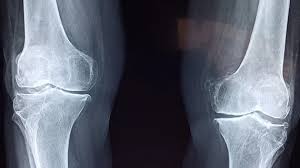Image result for Knee XRay