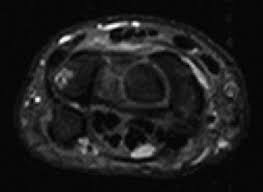 Image result for Ballottable Patella Sign