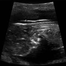 I have a detailed anatomy scan scheduled for when i'll be exactly 19 weeks along. Nuchal Translucency Radiology Reference Article Radiopaedia Org
