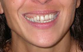 However, this procedure may only be suitable for almost negligible to moderate cases of gummy smile that involves the upper lip. Treating A Gummy Smile And Straightening The Teeth Without Orthodontics Anti Age Magazine