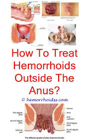 Pin On Hemorrhoids Remedie