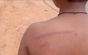 Child returns home with bruises after punishment by teacher in Karnataka -  The Hindu
