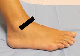 Although the ankle sprain is a relatively benign injury, inadequate rehabilitation can lead to residual symptoms after lateral ankle sprain affect 55% to 72% of patients at 6 weeks to 18. Dynamic High Resolution Us Of Ankle And Midfoot Ligaments Normal Anatomic Structure And Imaging Technique Radiographics