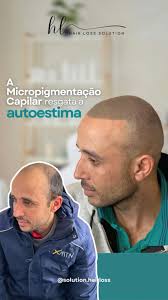 Hair Loss/ Baldness...