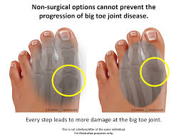 It looks like it is one bone, but it is actually made up of 22 separate bones that are cemented together along rigid joints called sutures. Big Toe Joint Pain Limited Painful Motion Hyprocure The Proven Solution To Misaligned Feet