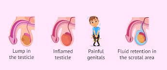 If found early, a testicular tumor may be about the size of a pea or a marble, but it can grow much larger. Possible Symptoms Of Testicular Cancer
