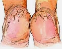 Crevasse Au Talon Et Soins Naturels Crevasse Au Pied Remedes Et Recette Maison Soins Naturels Sante Beaute Remedes Naturels