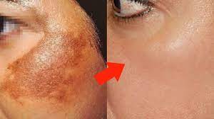 Aplicalo En La Cara Por 30 Dias Y No Tendras Ni Una Mancha Youtube Recetas De Belleza Natural Recetas De Belleza Tinte Natural Para Canas