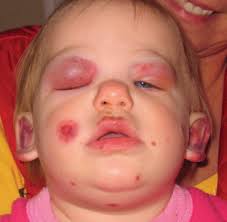 How to deal with mosquito bites on. Am Schnellsten Bug Bite On Eyelid Swollen