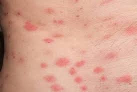 Bug boys pest control was founded by rory mccarty in august of 2013. What S Biting You At Night 5 Bugs That Are Leaving Nasty Red Bite Marks On Your Skin While You Are Asleep By Jason Dickson Medium