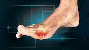 They usually occur after an acute injury although repetitive forced upward movement of the great toe may also lead to an injury of the tissue. Turf Toe Physiopedia