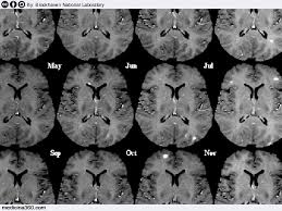 È complessa e imprevedibile, ma non è contagiosa né mortale. Sclerosi Multipla Sintomi Cure Cause E Diagnosi Della Sclerosi A Placche