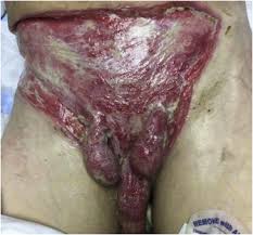 Fournier's gangrene is a form of necrotising fasciitis that affects the perineum. Extensive Necrotizing Fasciitis From Fournier S Gangrene Sciencedirect