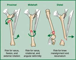 Universal size available in 18 and 22 leg lengths. Femoral Shaft Thoracic Key