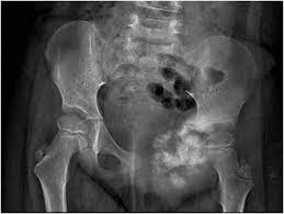Sometimes, osteosarcoma tumor may be increased and seen at the outside of bones which is known. Pelvic Bone Sarcomas Controversies And Treatment Options In Journal Of The National Comprehensive Cancer Network Volume 8 Issue 6 2010