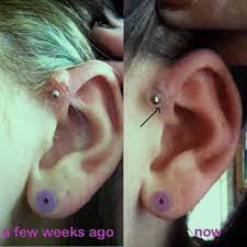 A Shop In The Uk Had This Customer Who Developed A Large Cyst Though It Was Larger Than The Nopull Piercing Disc Piercings Faciales Piercings Oreja Piercings