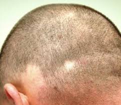 Progressive pattern hair loss is a common occurrence among men, and since the beginning of recorded history, men and women have searched out cures for hair loss. Hair Loss Comes And Goes Always Causing Distress Clinician Reviews