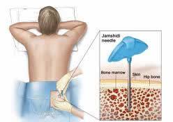 Planning to do your blood cancer treatment in india? Leukemia Blood Cancer Treatment Cost In India Indianmedguru