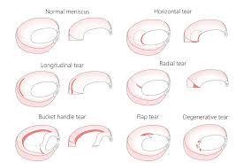 Surgery can be used to stabilize some meniscus tears. Meniscal Tear Have You Torn Your Meniscus