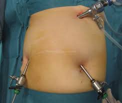 Laparoscopic gallbladder surgery