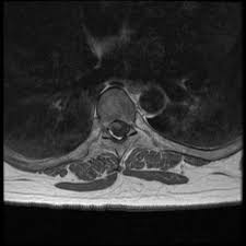 Brown Sequard Syndrome Radiology Reference Article Radiopaedia Org
