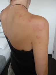 Bedbugs do not seem to spread disease to people. Bed Bug Bites Bed Bug Bites Bed Bugs Bites Skin Bed Bugs