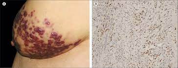 Kaposi sarcoma is a disease in which cancer cells are found in the skin or mucous membranes that line the gastrointestinal (gi) tract, from mouth to anus, including the stomach and intestines. Atypical Presentation Of Classic Kaposi S Sarcoma The Lancet